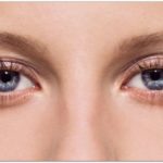 Способы устранения аллергических отеков глаз